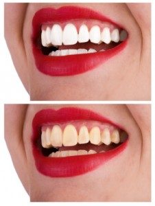 How To Make Your Teeth White         