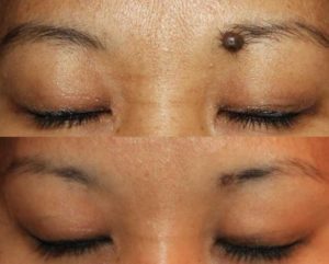 mole-removal-in-eyebrow